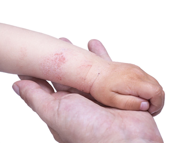 Consejos para prevenir los brotes de dermatitis en invierno